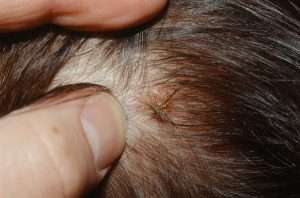 łojotok skóry głowy leczenie gliwice