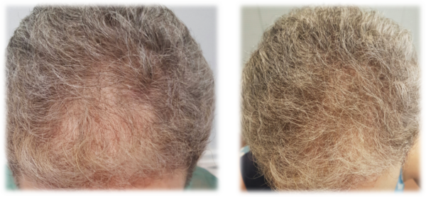 włosy męskie przed i po zabiegu