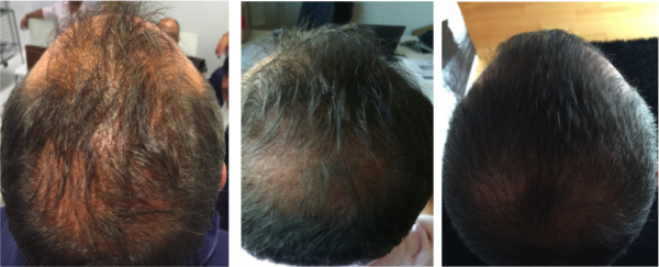 włosy męskie przed i po zabiegu